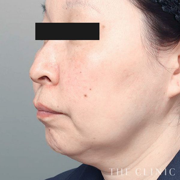 糸リフトの症例