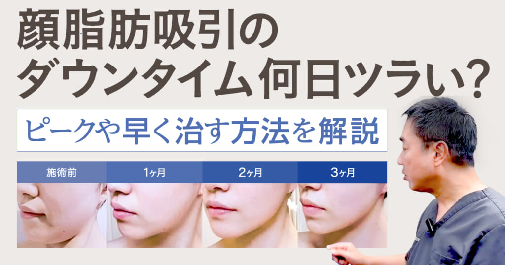 顔脂肪吸引のダウンタイムは何日ツラい？ピークや早く治す方法を解説