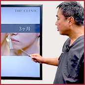 顔脂肪吸引のダウンタイムは何日ツラい？ピークや早く治す方法を解説