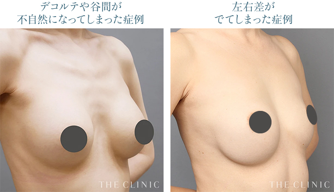 豊胸後にデコルテや谷間、左右差が不自然になったバスト