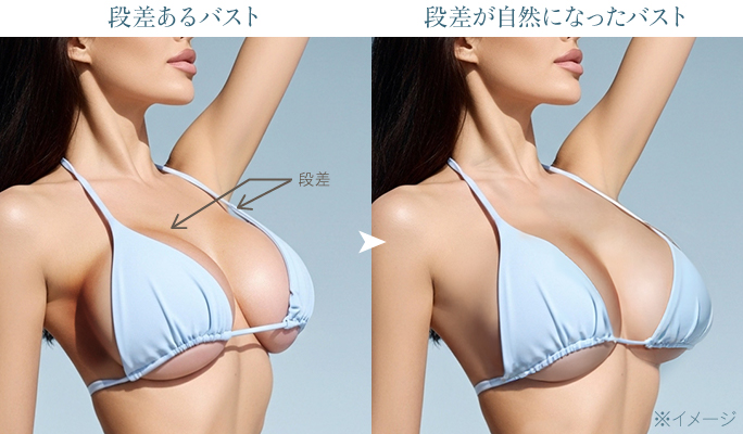 シリコンバッグ豊胸後の不自然な形を改善