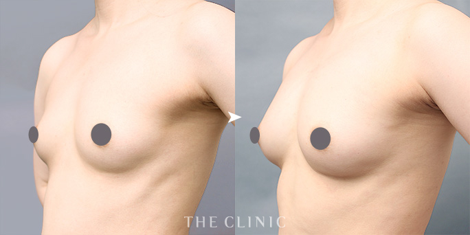 ザクリニック志田ドクターが執刀した脂肪注入豊胸