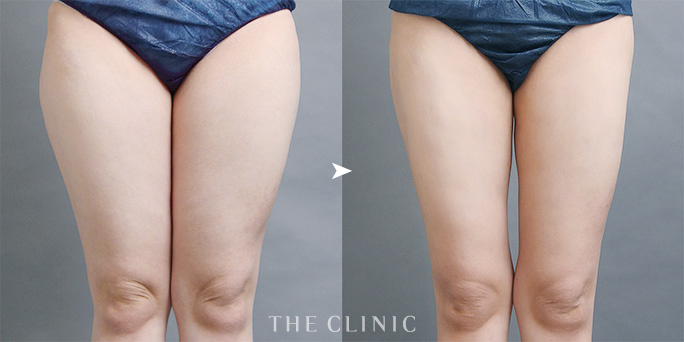 ザクリニック志田ドクターが担当した太もも脂肪吸引の症例