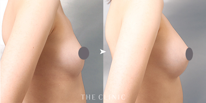 ザクリニック村田ドクターが執刀した脂肪注入豊胸