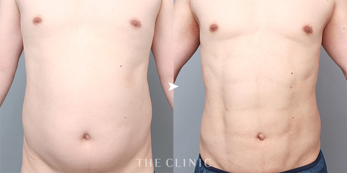 ザクリニック村田ドクターが担当した男性腹部の4D脂肪吸引の症例