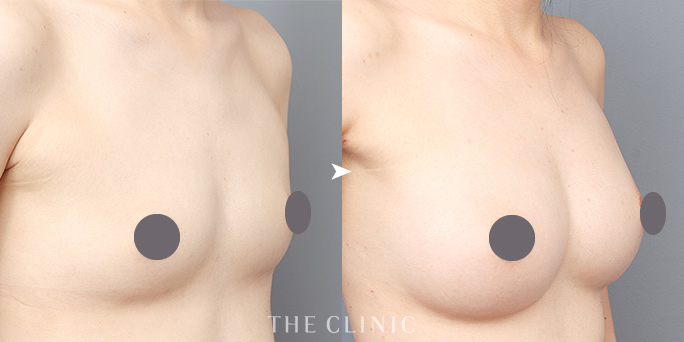 ザクリニック今西ドクターが執刀した脂肪注入豊胸(3回)