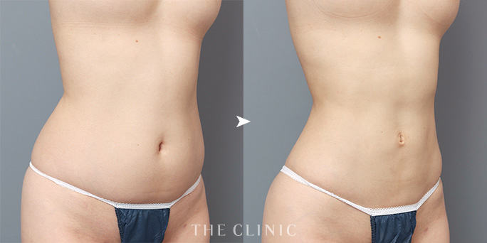 ザクリニック今西ドクターが担当したお腹の脂肪吸引症例