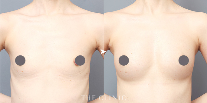 ザクリニック帯包ドクターが執刀したコンデンスビブラ豊胸