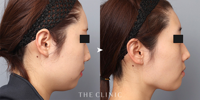 ザクリニック帯包ドクターが担当した顔(頬・顎下)脂肪吸引の症例