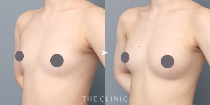 ザクリニック三塚ドクターが執刀したコンデンスリッチ豊胸