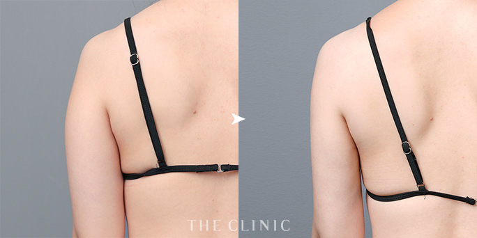 ザクリニック三塚ドクターが担当した二の腕の脂肪吸引の症例