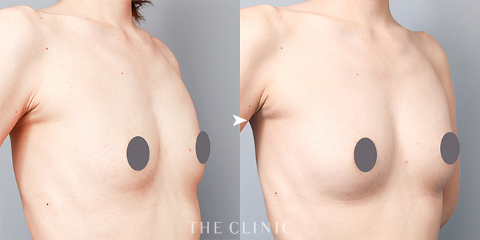 ザクリニック吉田ドクターが執刀した上向きバスト豊胸