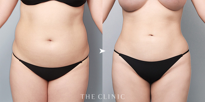 ザクリニック吉田ドクターが担当したお腹の脂肪吸引の症例