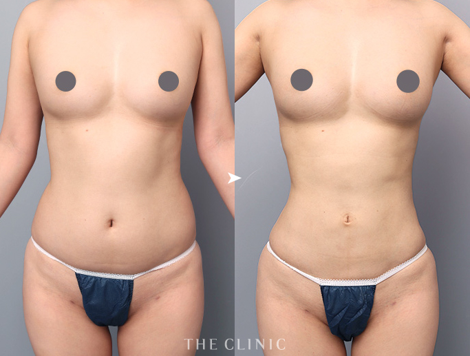 ザクリニック今西医師が担当した脂肪豊胸のバストと採取部位のお腹の症例