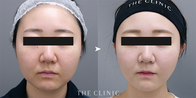 ザクリニック広島・黒澤医師担当の顔脂肪吸引の症例