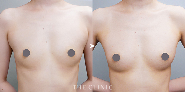 ザクリニック広島の木村圭吾医師の脂肪豊胸の症例