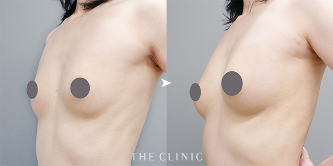ザクリニック広島の木村圭吾医師が執刀した40代痩せ型女性の脂肪豊胸症例