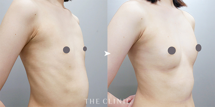 ザクリニック広島の木村圭吾医師が執刀した20代痩せ型女性のビブラ脂肪豊胸症例