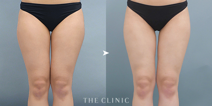 ザクリニック広島・木村医師担当の太もも脂肪吸引の症例
