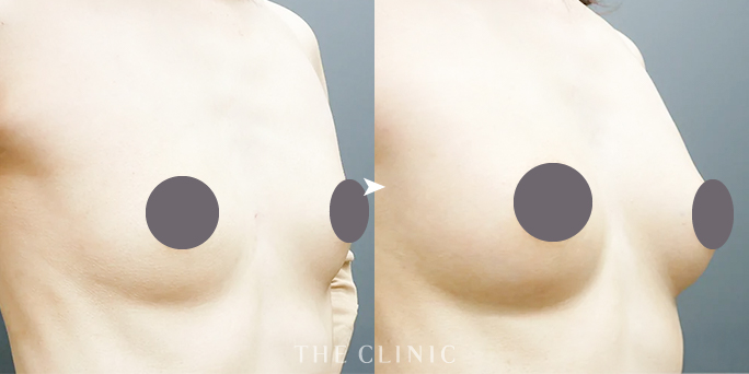ザクリニック広島の木村圭吾医師が執刀した40代女性の脂肪豊胸症例