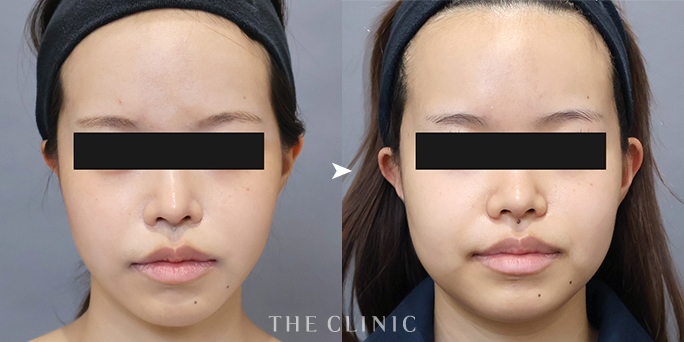 THE CLINIC名古屋院・加藤医師が執刀した20歳女性の顔の脂肪吸引症例
