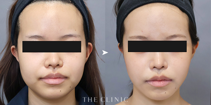 THE CLINIC名古屋院・加藤医師が執刀した20歳女性の顔の脂肪吸引症例