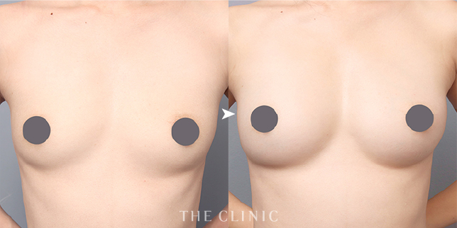 ザクリニック名古屋の帯包医師の脂肪豊胸の症例
