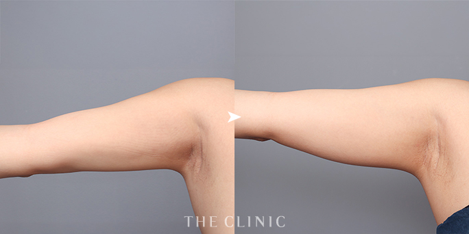 THE CLINIC名古屋院・帯包医師が執刀した29歳女性の二の腕脂肪吸引の症例