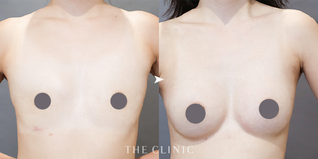 ザクリニック名古屋の帯包医師のハイブリッド豊胸の症例