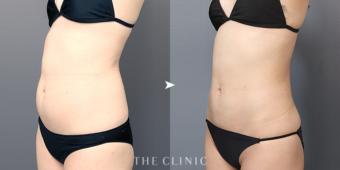 THE CLINIC名古屋院・帯包医師が執刀した24歳女性のお腹の脂肪吸引症例