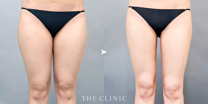 THE CLINIC名古屋院・加藤医師が執刀した25歳女性の太もも脂肪吸引症例