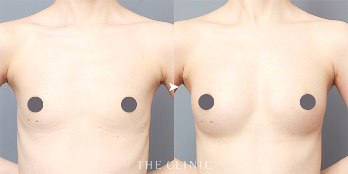 ザクリニック名古屋の帯包医師のコンデンスビブラ豊胸の症例