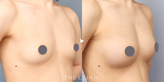 ザクリニック名古屋の帯包医師の上向きバスト豊胸の症例