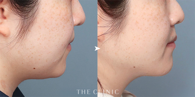 ザクリニック大阪・安部医師の顔の脂肪吸引症例（27歳女性）