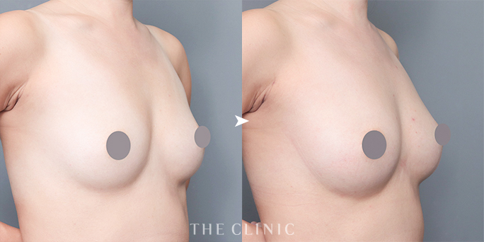 ザクリニック安部ドクターが執刀した34歳女性のコンデンスリッチ豊胸（脂肪豊胸）の症例画像