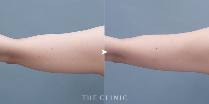 ザクリニック大阪・木村医師の二の腕脂肪吸引の症例（39歳女性）
