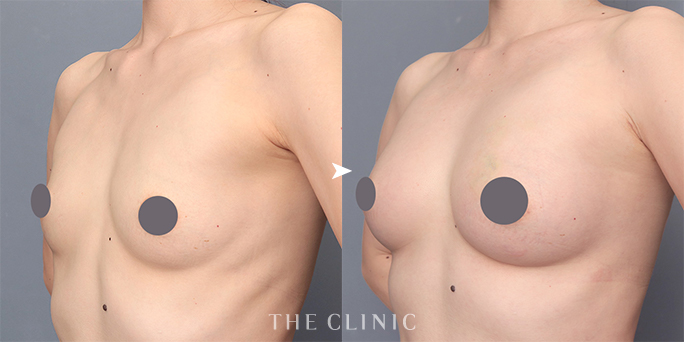 ザクリニック安部医師が執刀した授乳後女性の脂肪注入豊胸の症例画像