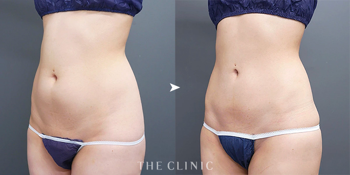 ザクリニック大阪・安部医師のお腹の脂肪吸引症例（26歳女性）