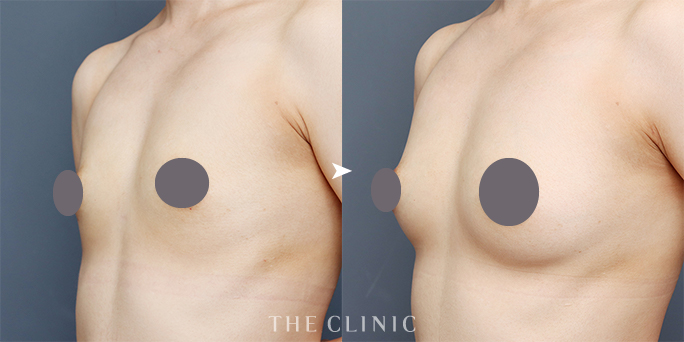 ザクリニック安部医師が執刀した脂肪豊胸の症例画像