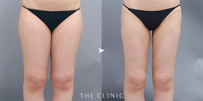 ザクリニック大阪・黒澤医師の太もも脂肪吸引症例（24歳女性）