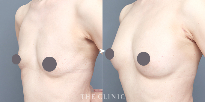 脂肪注入豊胸の症例（執刀医：ザクリニック安部医師）