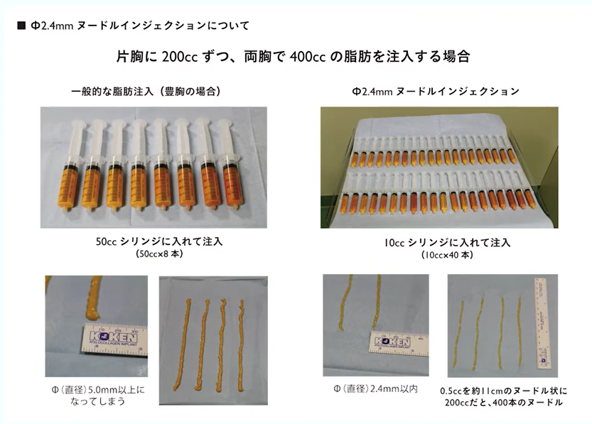 脂肪注入でしこりを作らないための方法:2.4mmヌードルインジェクション