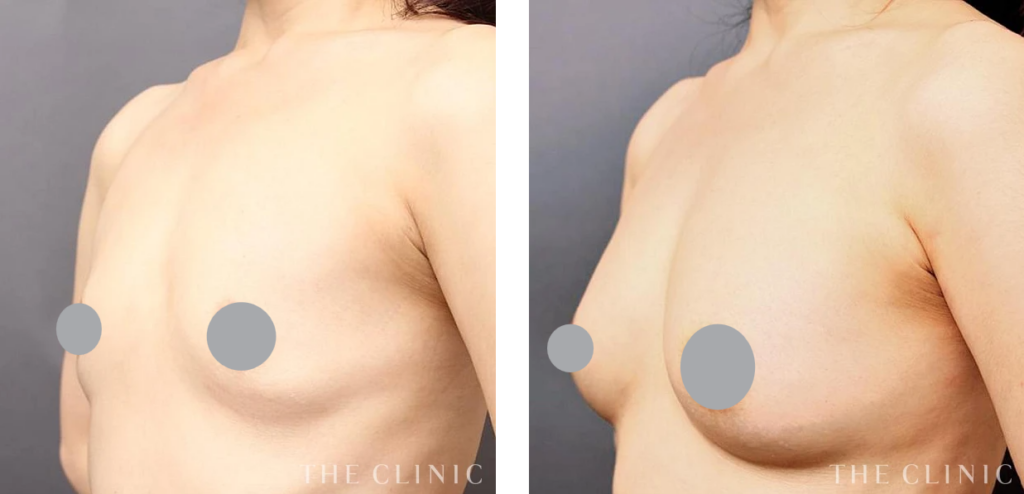 47歳女性の授乳後の脂肪注豊胸症例