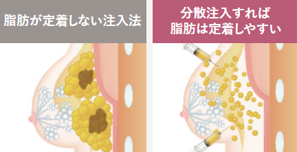 脂肪注入でしこりを作らない方法:分散して注入する