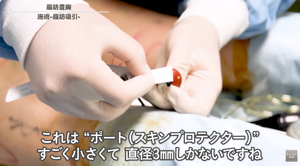 脂肪注入豊胸で脂肪採取する際傷跡を防ぐスキンポート