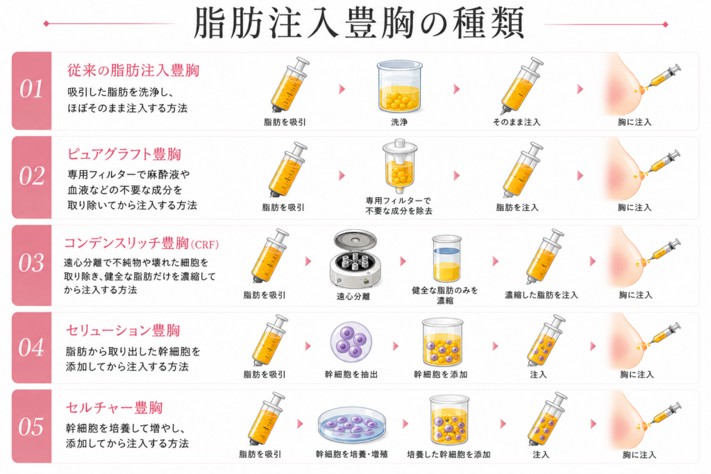 脂肪注入豊胸の5つの種類と加工工程の比較図