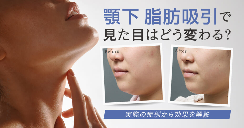 顎下脂肪吸引で見た目はどう変わる?実際の症例から効果を解説