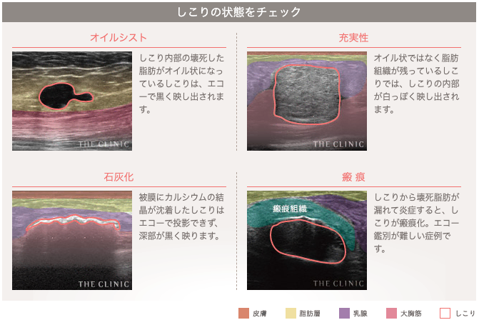 脂肪注入豊胸のしこりの状態