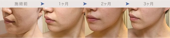 頬・顎下の脂肪吸引１～３か月後のダウンタイム経過写真