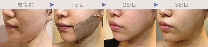 頬・顎下の脂肪吸引１～３日後のダウンタイム経過写真